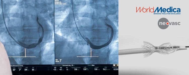 En la foto se aprecia el dispositivo Reducer implantado (imagen del lado izquierdo del monitor)