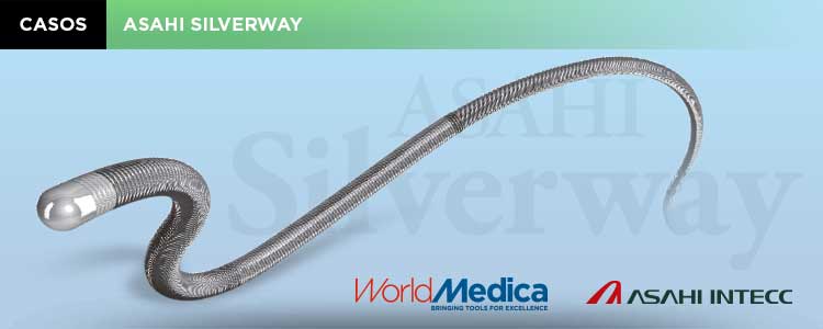 Caso: Utilidad de la Guía Silverway. Estudio vascular del eje aorto-ilíaco-femoral PRE-TAVI, a través de radial derecha