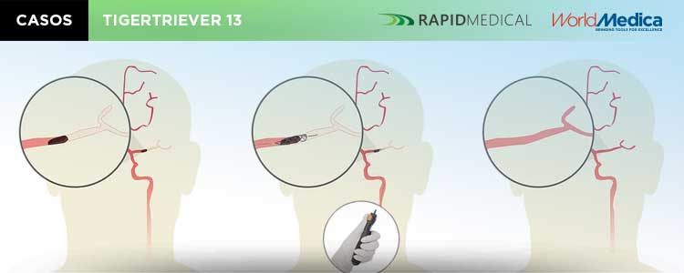 Case Report Tigertriever 13 - Caso realizado con nuestro dispositivo extractor de trombos