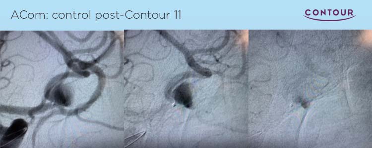 Sistema Neurovascular Contour: primeros casos en España tratados con éxito