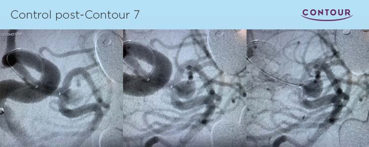 Sistema Neurovascular Contour: primeros casos en España tratados con éxito