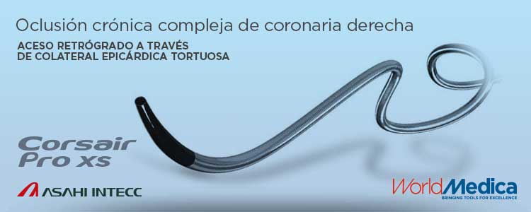Caso: Oclusión crónica compleja de coronaria derecha. Acceso retrógrado a través de colateral epicárdica tortuosa